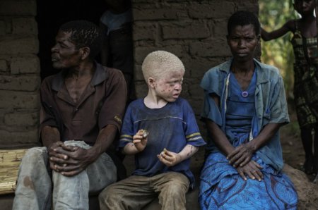 Проклятие белой кожи - в Африке охотятся на альбиносов