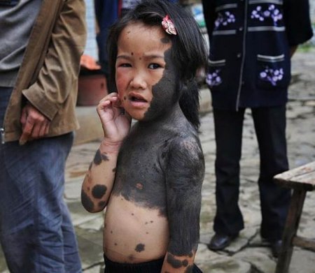 В Китае живет ребенок-"оборотень". ФОТО