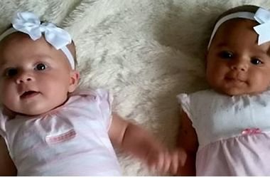 В Англии родители не сразу поняли что родились близнецы с разным цветом кожи
