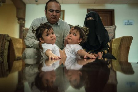 В Саудовской Аравии провели успешную операцию по разделению девочек "сиамских близнецов". ФОТО