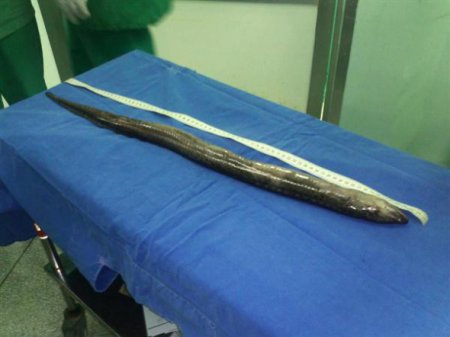 В Бразилии врачи сделали операцию по удалению живой рыбы из ануса мужчины. Видео 18+