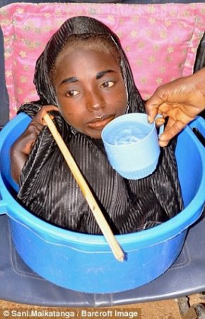 Жуткие кадры: Девушка из Нигерии с телом младенца живет в тазу. ФОТО