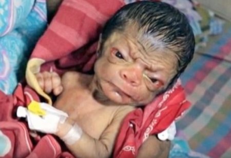 В Бангладеш родился ребенок с лицом 80-летнего старика