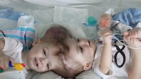 В США хирурги разъединили головы сиамских близнецов