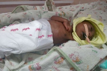 В Индии родители отказались от 2-недельного малыша после того, как взглянули на его лицо: фото