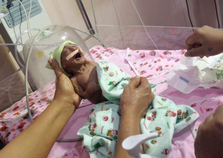 В Индии родители отказались от 2-недельного малыша после того, как взглянули на его лицо: фото