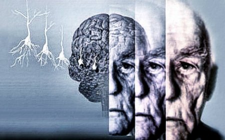 Ученые назвали первый признак развития болезни Альцгеймера