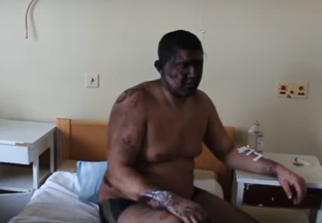 Опубликовано видео с пострадавшими шахтерами, которые находятся в больнице